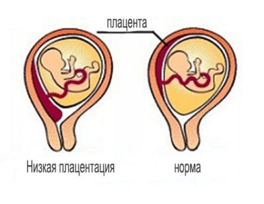 Можно Ли Секс При Низкой Плацентации