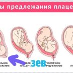 Вот на четвертом изображении плацента перекрывает зев