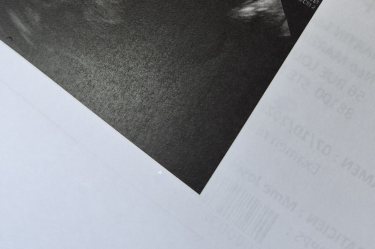 Ciao ragazze. Tanto stress, non potrei avere gemelli. L'eco precoce è stata fatta la settimana scors…
